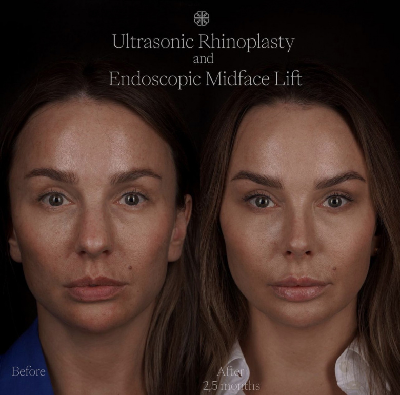 Ultrasonic rhinoplasty and endoscopic midface lift