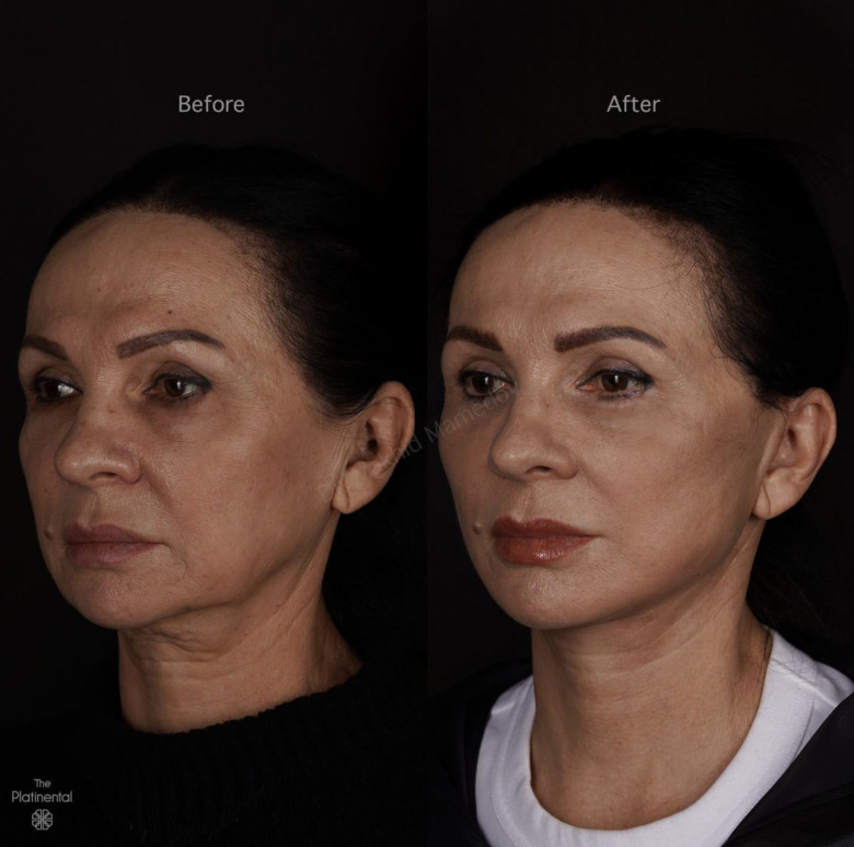 Endoscpic forehead and brow lift