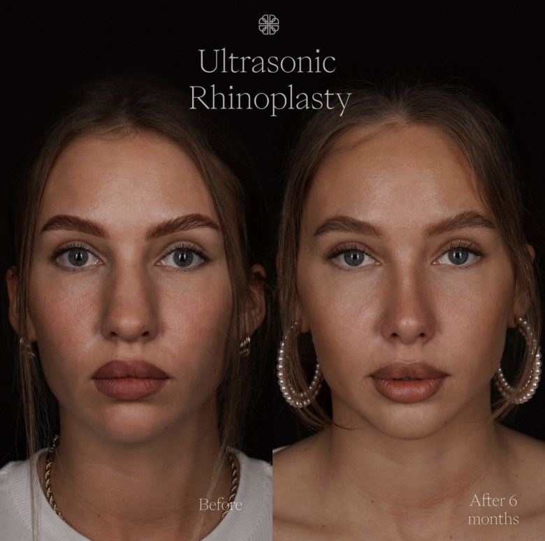 Ultrasonic rhinoplasty